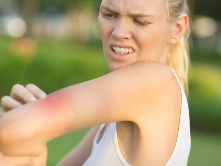 A woman outdoors grimaces in pain, scratching her red, irritated arm with her other hand.